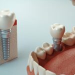 İmplant Tedavisi Neden Tercih Edilir?