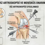 Diz Artroskopisi Nedir? Kapalı Diz Ameliyatı ile Modern Tedavi Yaklaşımı